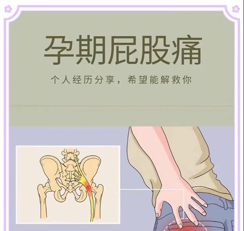 坐骨神经痛的治疗和缓解方法（针对坐骨神经痛患者的有效疗法和自我护理方法）